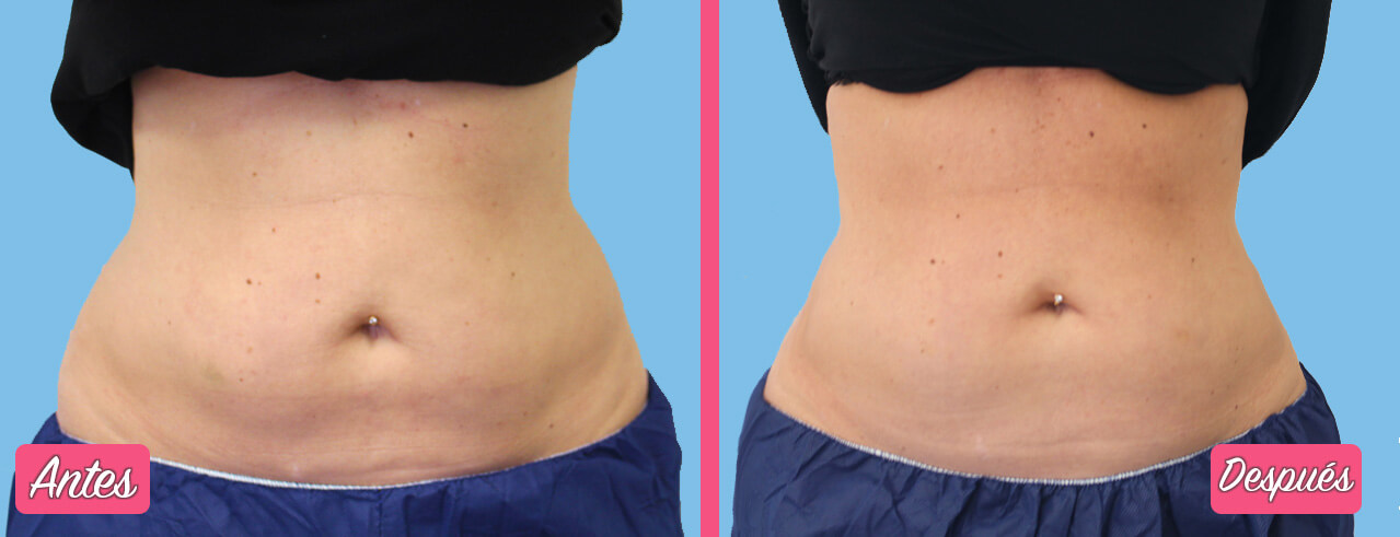 ¿Cuáles son los Resultados de la Liposucción Sin Cirugía?