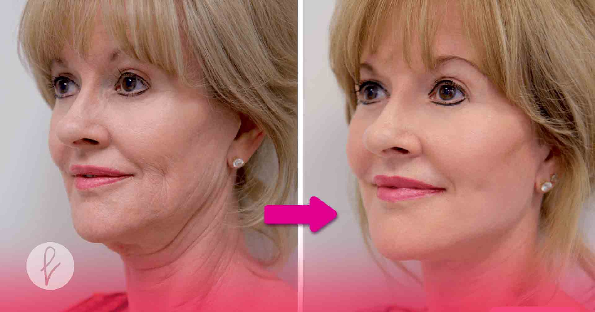 ¿Cómo se Realiza el Lifting Facial?