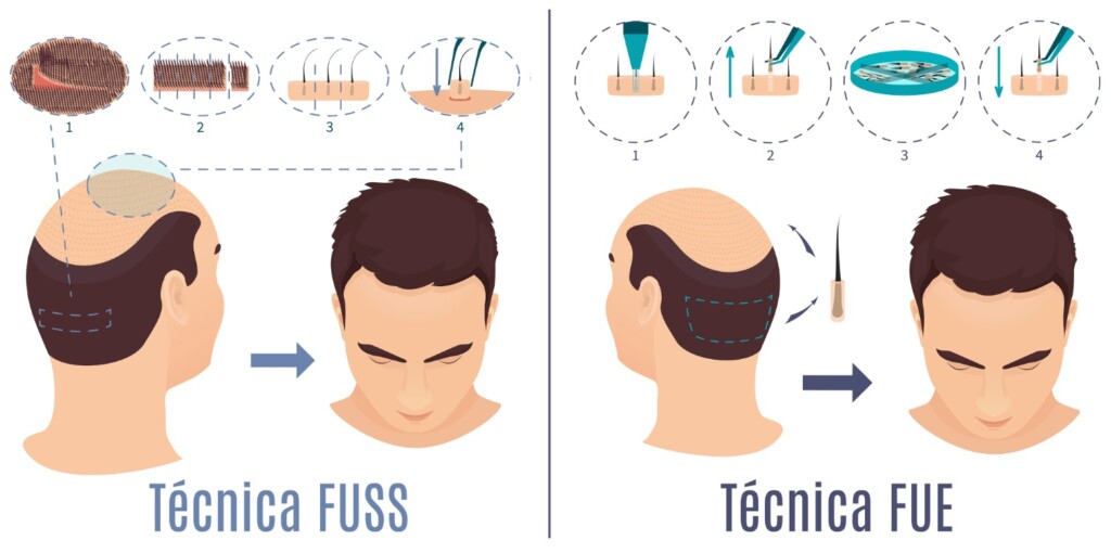 ¿Qué es un Trasplante de Cabello?