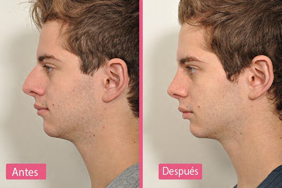 Resultados luego de la Recuperación de la Rinoplastia