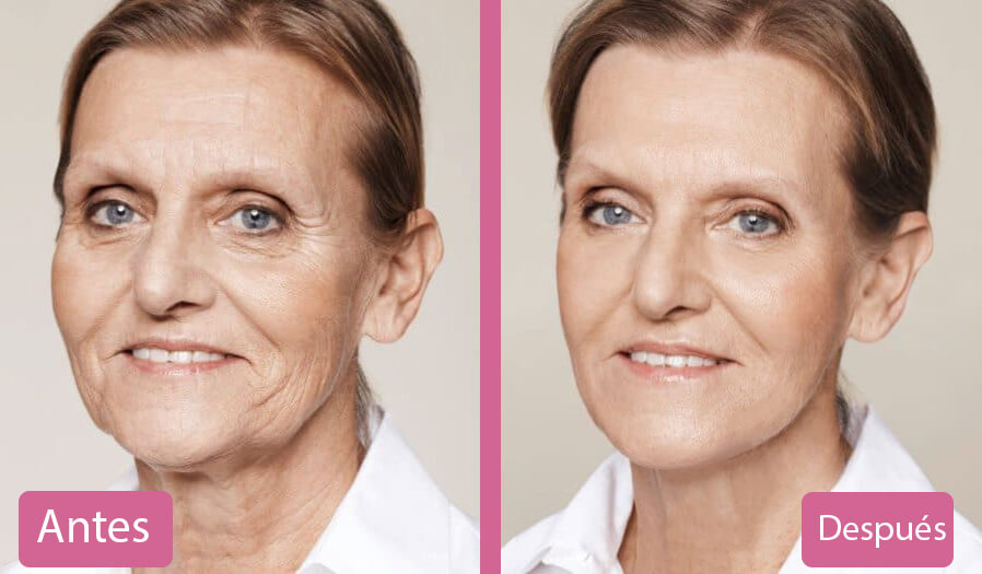 Técnicas de Rejuvenecimiento Facial Antes y Después