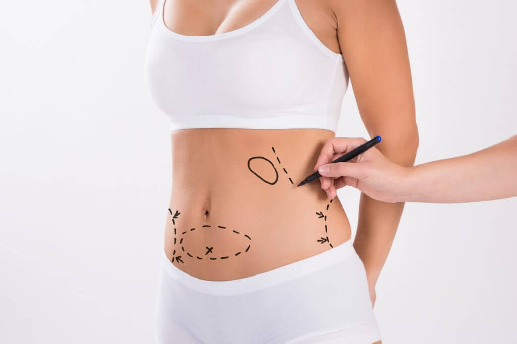 ¿Cuáles son los Tipos de Liposucción que Existen?