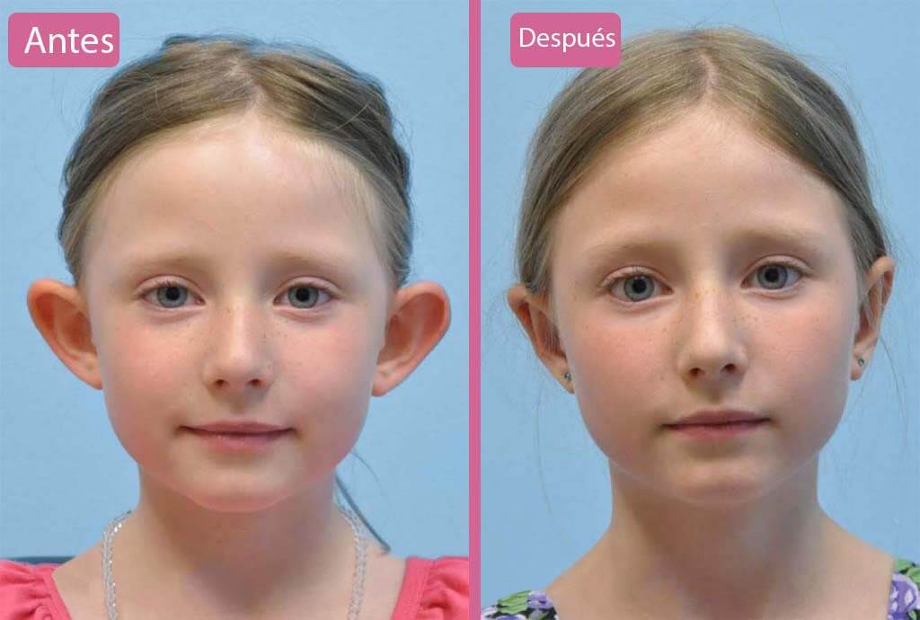 Otoplastia Infantil Antes y Después