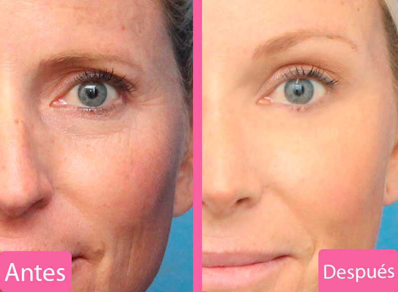 Tipos de Brow Lift o Levantamiento de Cejas