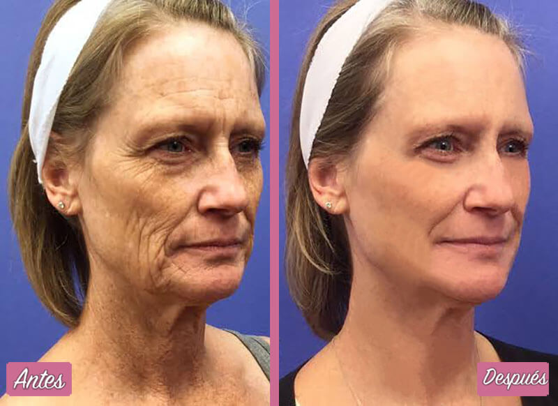 Resultados del Rejuvenecimiento Facial Láser