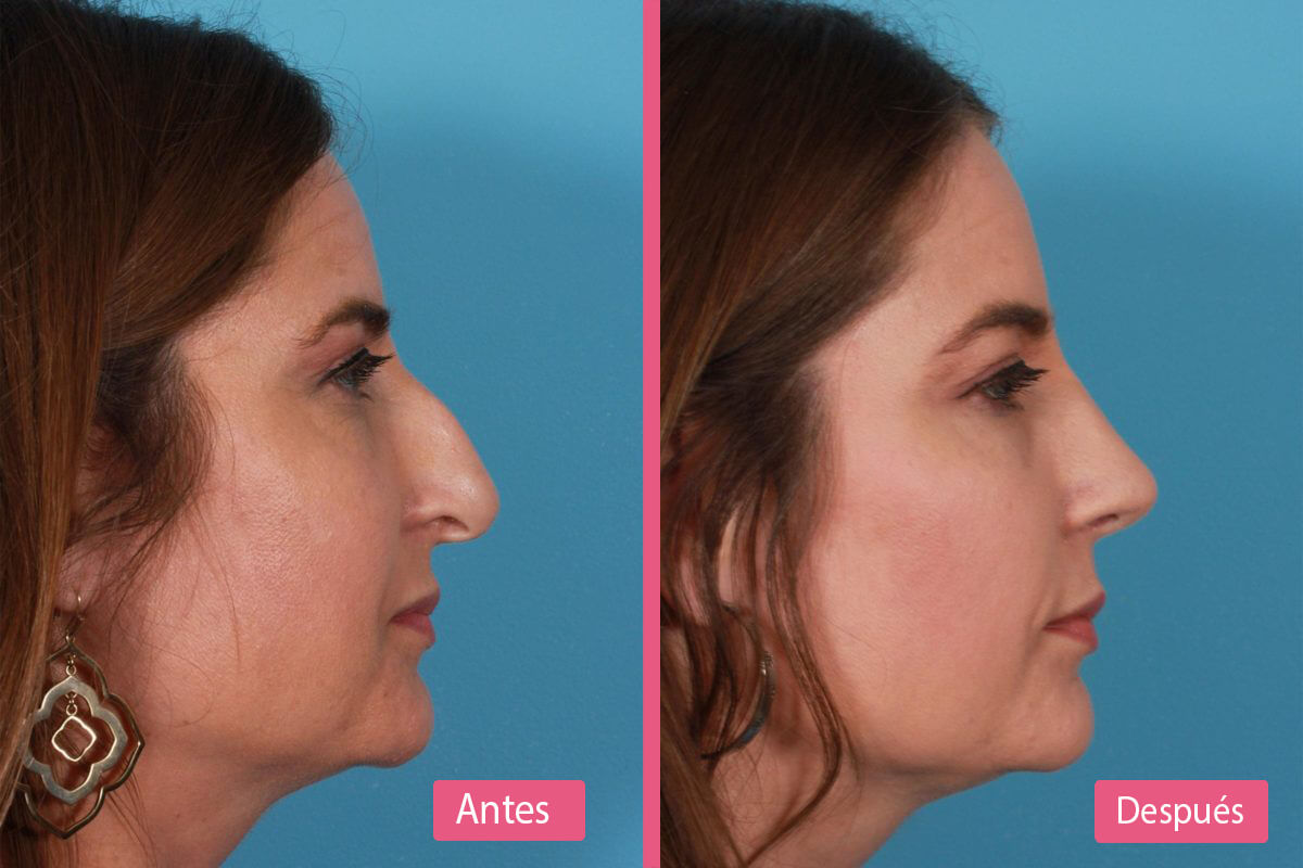 Etapas de Recuperación de la Rinoplastia