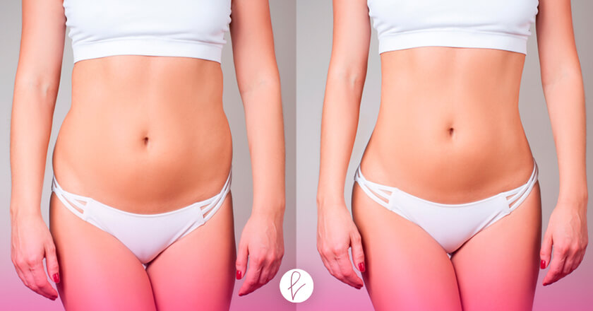 Lipoescultura: Antes y Después