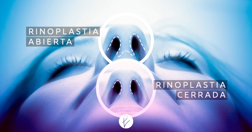 Tipos de Rinoplastia en Perú