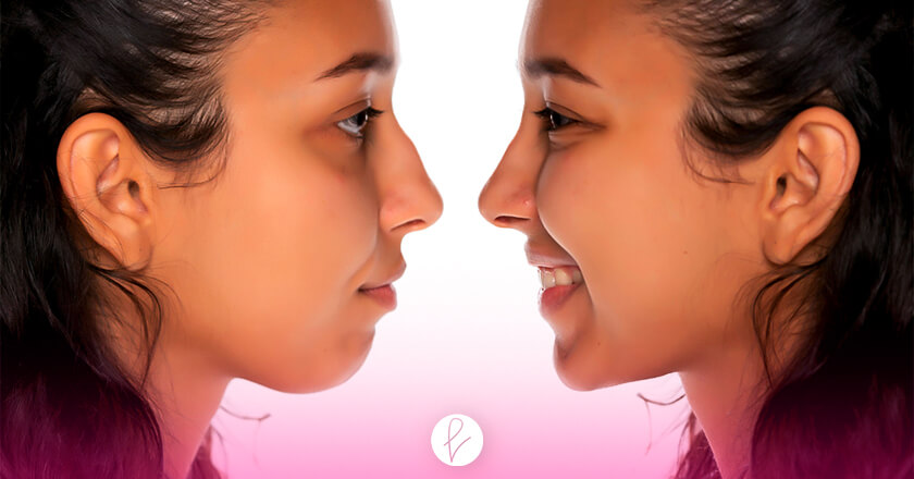 Resultados de una Rinoplastia