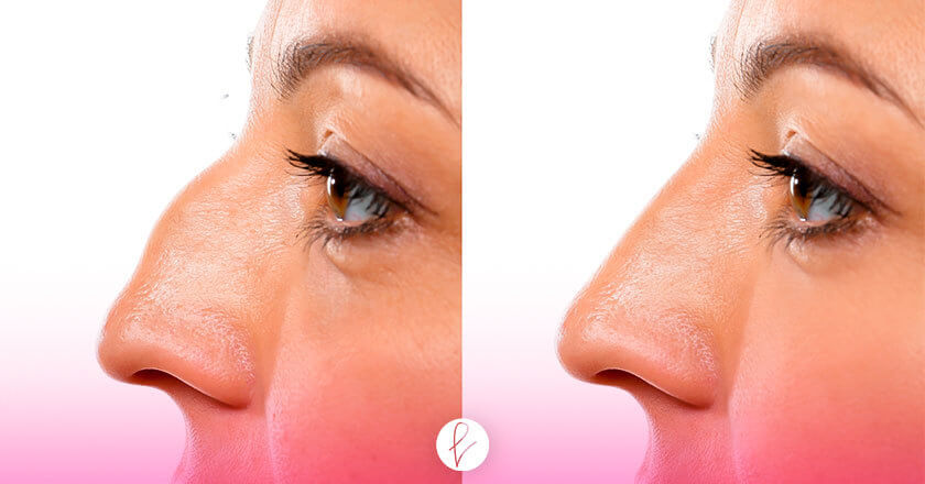 Diferencias entre la Rinoplastia y la Rinomodelación