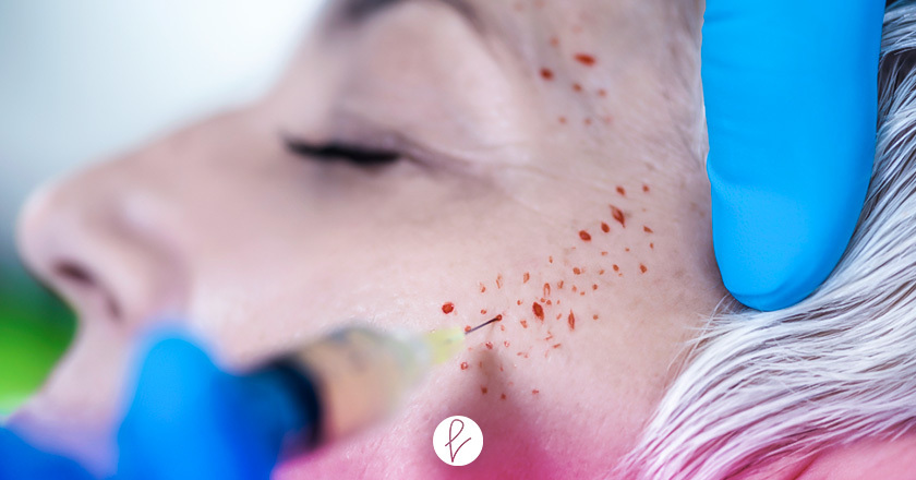 ¿Cuál es la ventaja del Plasma Rico en Plaquetas Facial frente a otros?