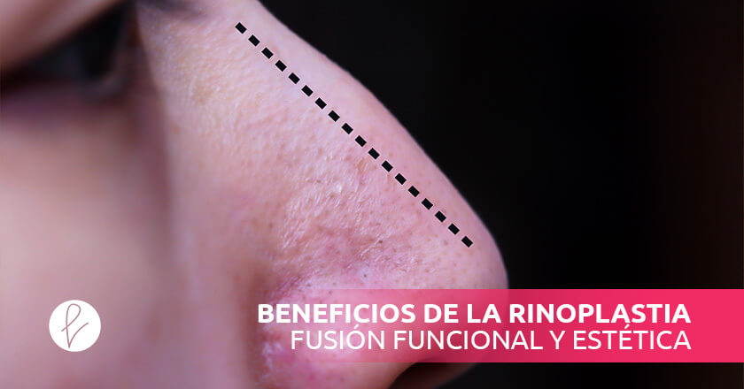 Rinoplastia fusión Funcional y Estética