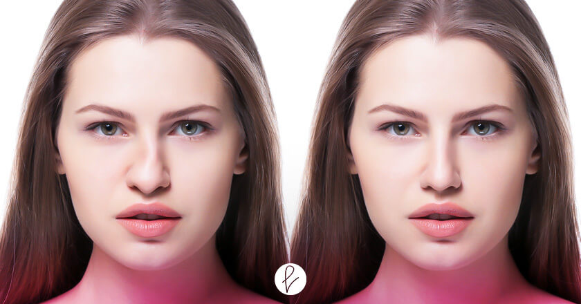 ¿Qué es la rinoplastia funcional?