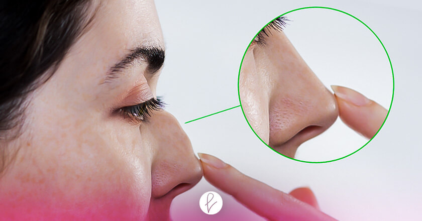 ¿Qué es la rinoplastia estética?