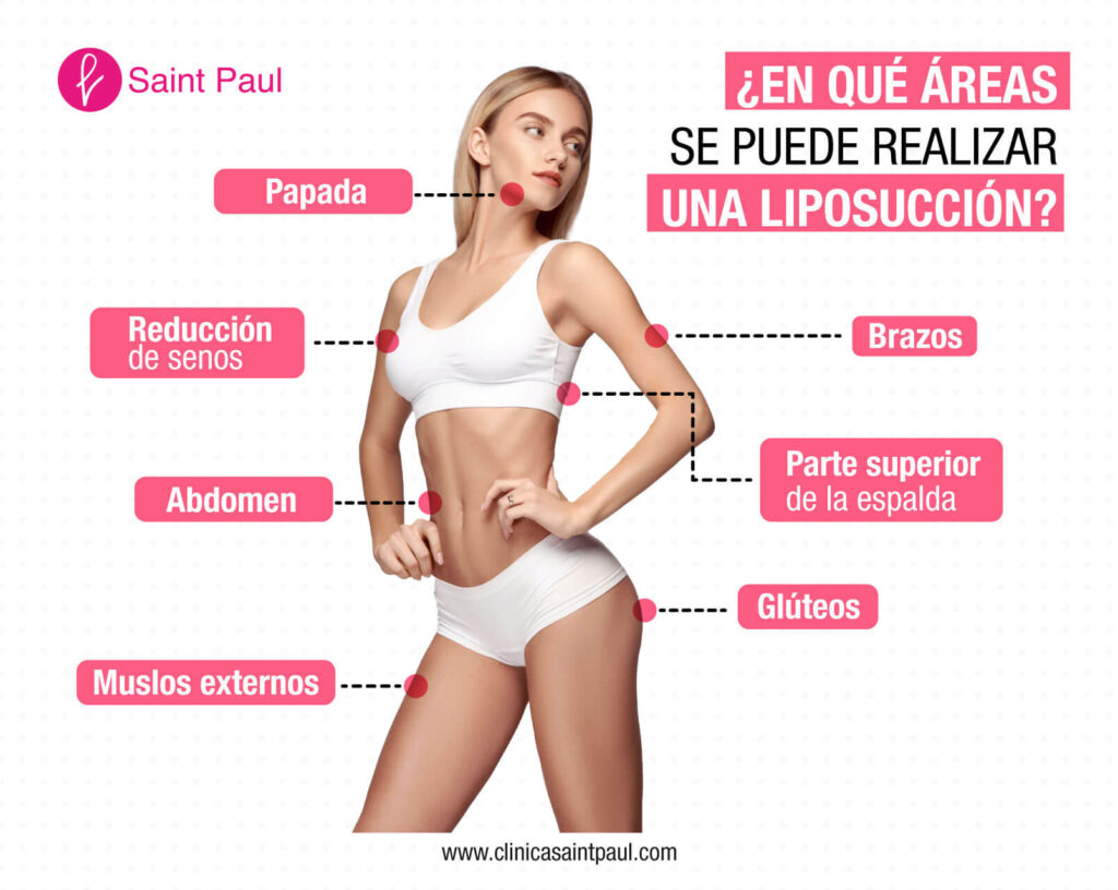 ¿En qué áreas se puede realizar una liposucción?
