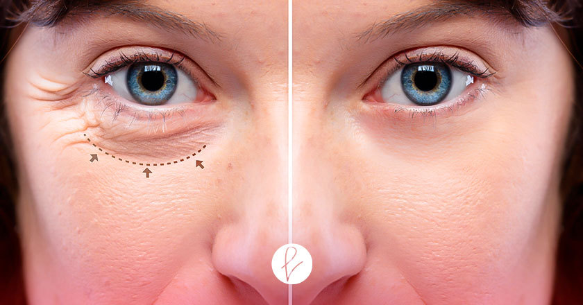 Procedimientos quirúrgicos para las bolsas de tus ojos