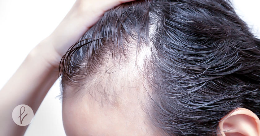 ¿Qué es la Alopecia?