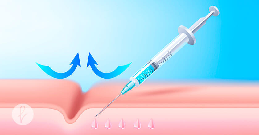 ¿Para qué sirve el Bótox?