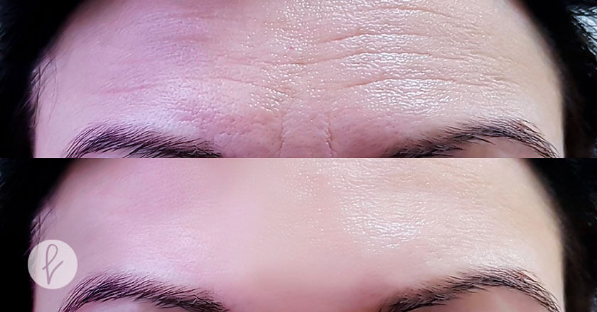 Cómo actúa el bótox para rejuvenecer la piel