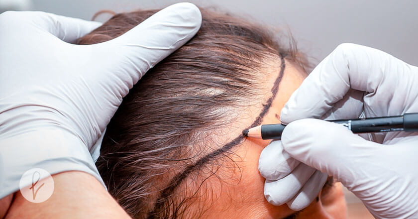 Implante de cabello