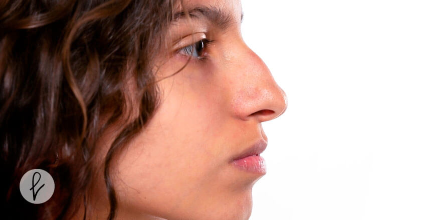 ¿Para qué realizarme una rinoplastia?