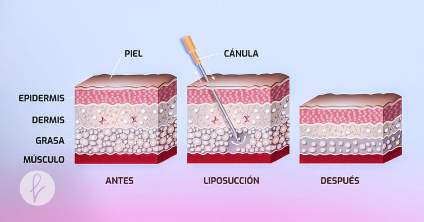¿Qué es la liposucción?