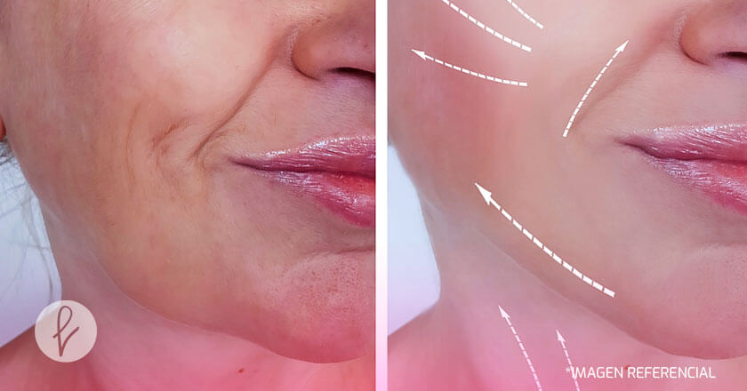 Resultados del lifting facial