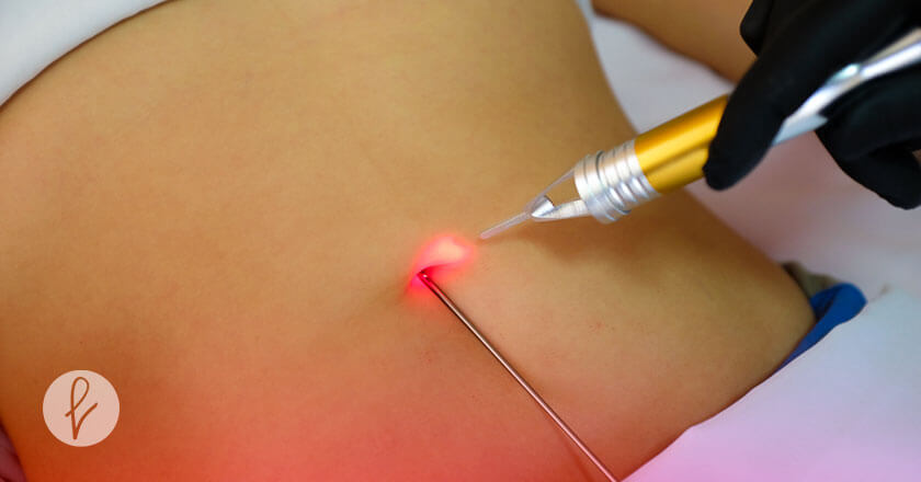 La liposucción asistida por láser