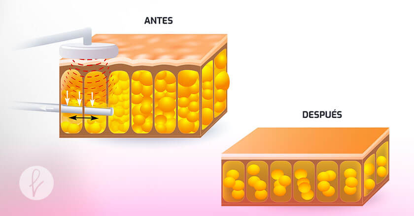 La liposucción asistida por ultrasonido