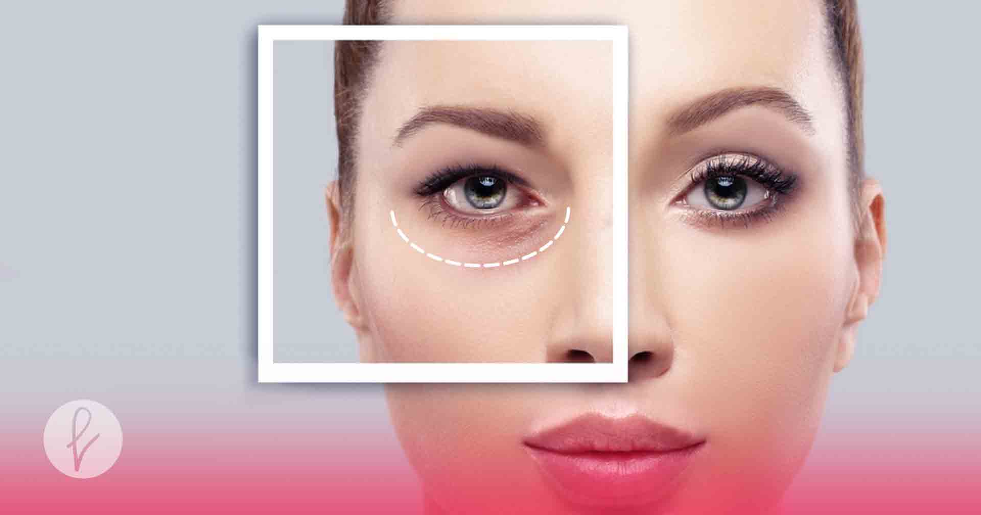 ¿Qué necesitas saber sobre la Blefaroplastia para eliminar surcos en bolsas de los ojos?