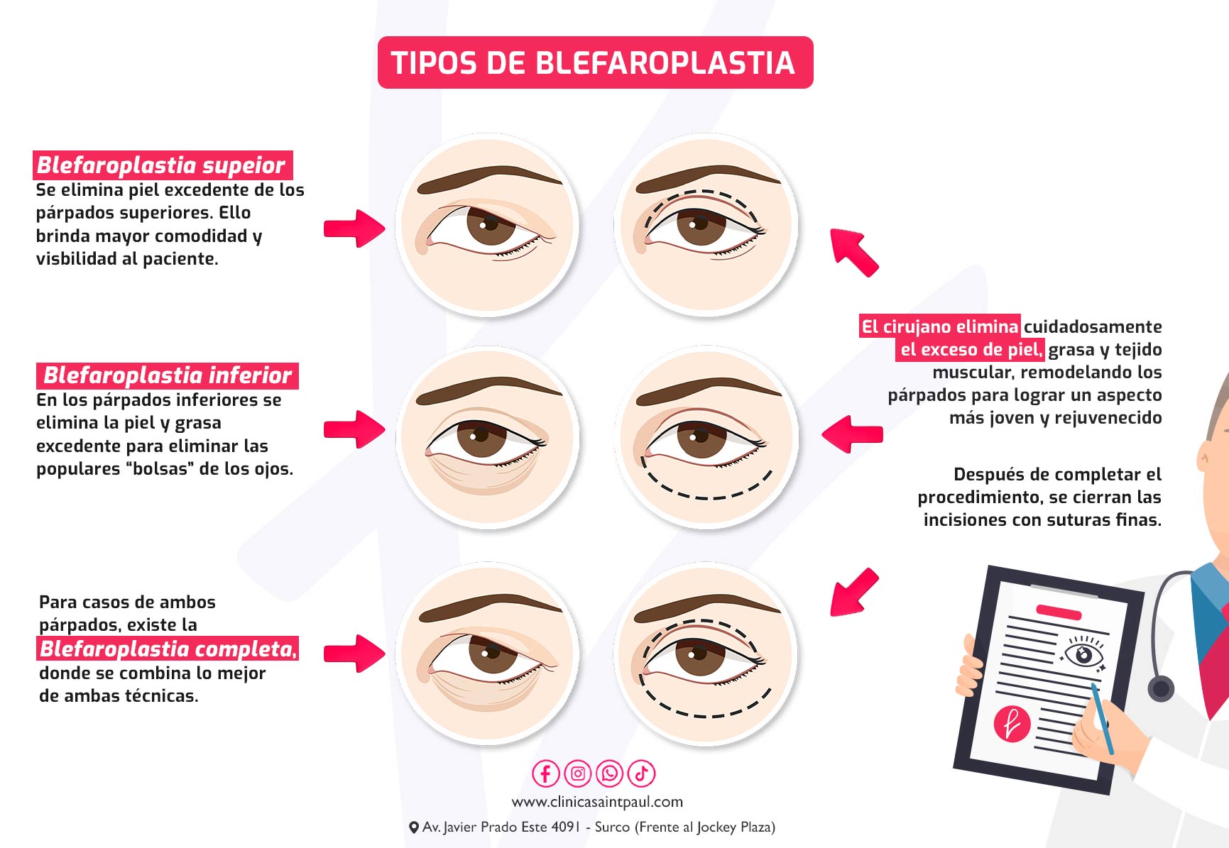 ¿Cómo se realiza la blefaroplastia para eliminar los surcos en las bolsas de los ojos?
