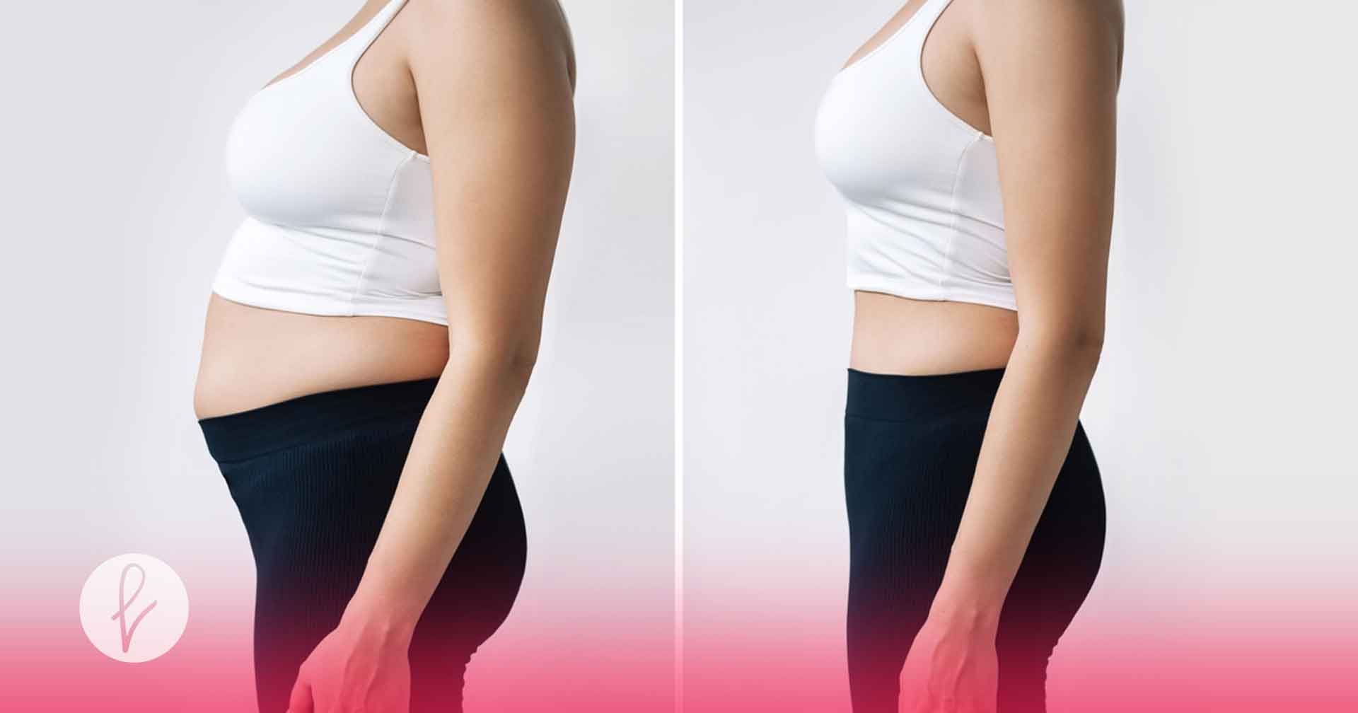 Abdominoplastia