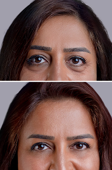 Blefaroplastia antes y después