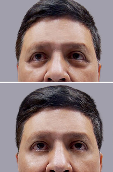 Blefaroplastia antes y después