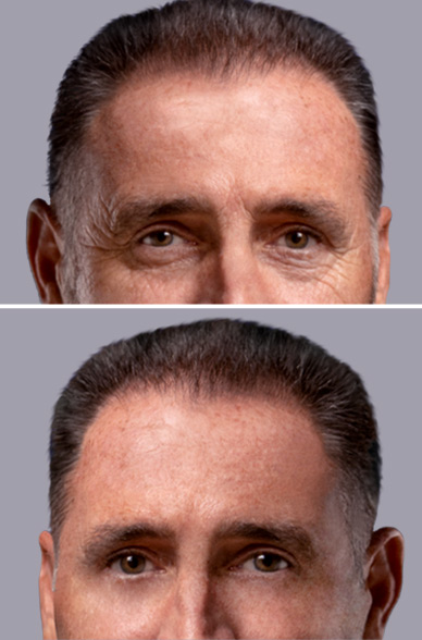 Blefaroplastia antes y después