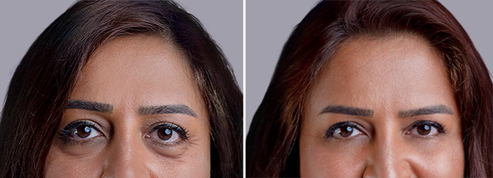 Blefaroplastia antes y después