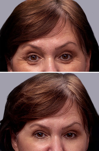 Blefaroplastia antes y después