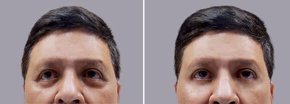 Blefaroplastia antes y después