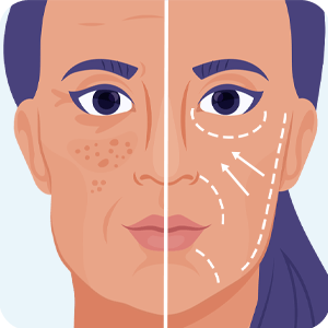 Lifting Facial Volumétrico Lifting Facial Volumétrico