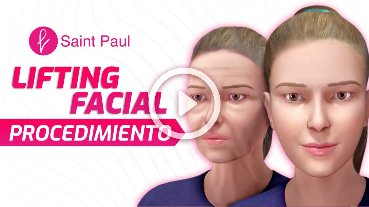 Procedimiento del Lifting Facial