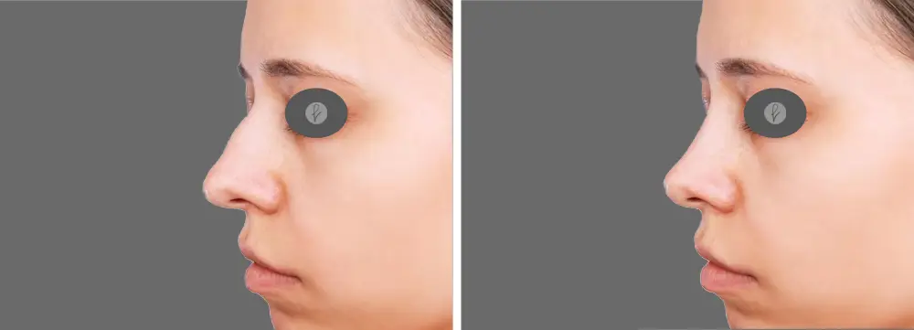 antes y después de ácido hialurónico