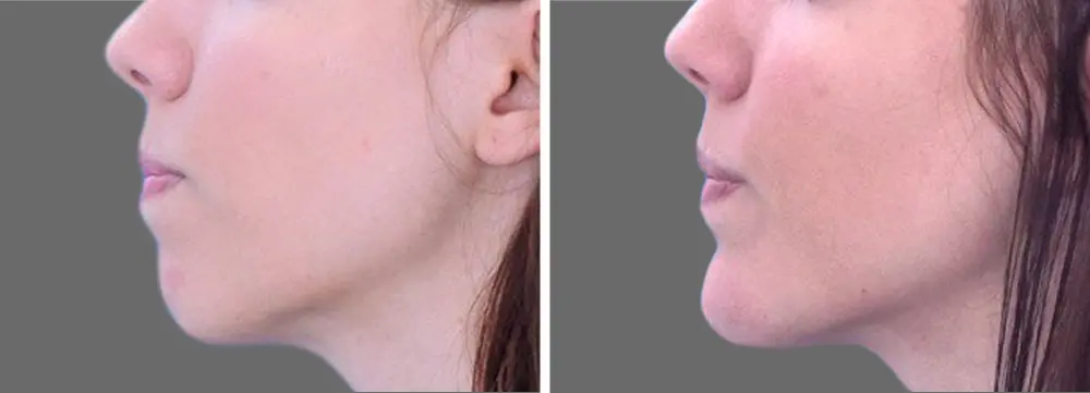 antes y después de ácido hialurónico