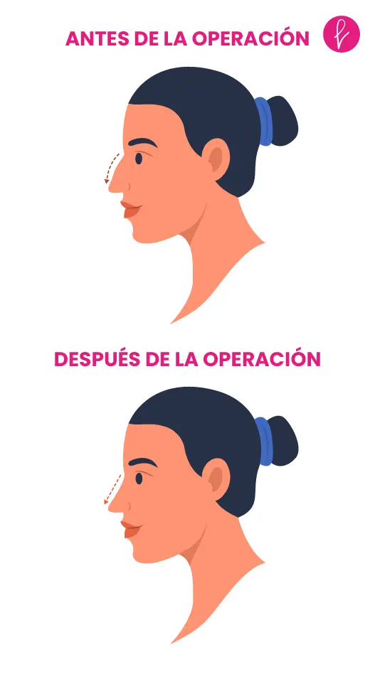 Rinoplastia Resultados Rinoplastia Resultados