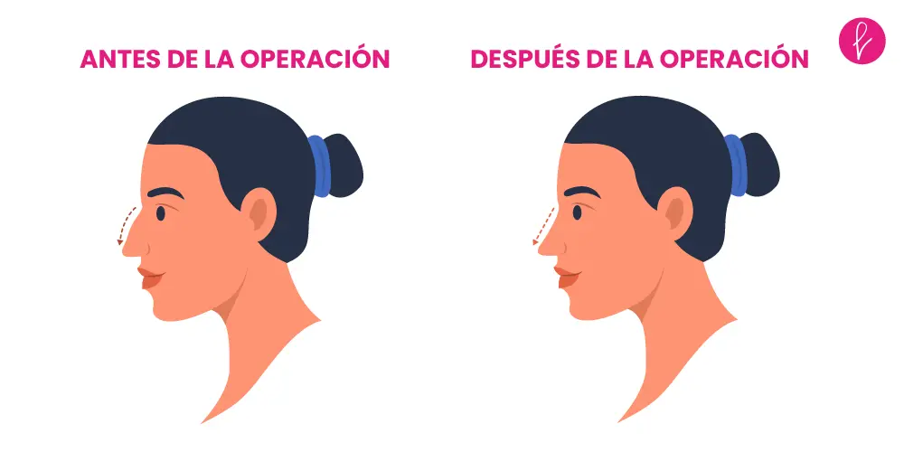 Rinoplastia Resultados Rinoplastia Resultados