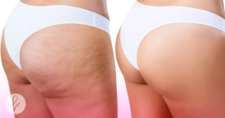 Reducción de la celulitis y la flacidez