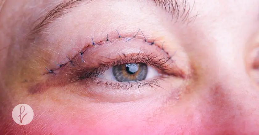 ¿Es una intervención complicada? ¿Es una intervención complicada?