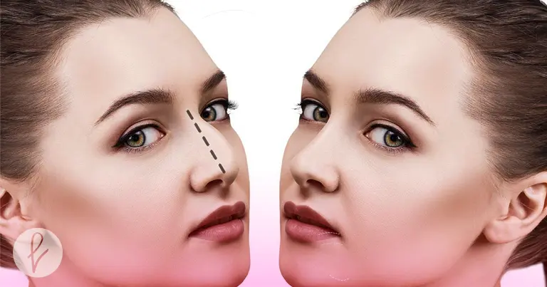 ¿En qué ocasiones se recomienda una rinoplastia secundaria?