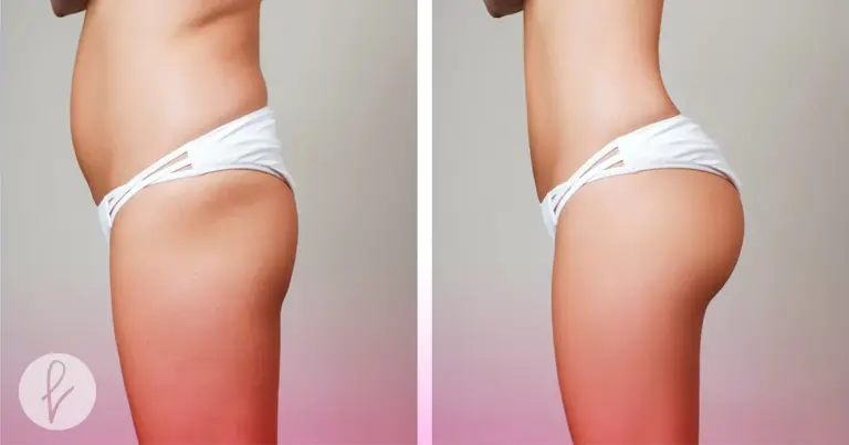 ¿Cómo es la Lipotransferencia en Senos y Glúteos?