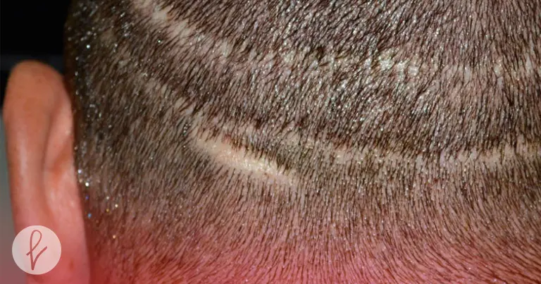 ¿Qué es el implante de cabello en cicatrices?