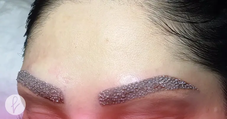 ¿Qué es el implante de Cabello en Cejas?